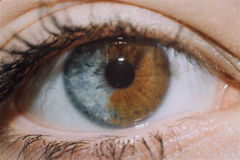 6 Fakta Heterochromia Sebab Kelainan Perbedaan Warna Mata