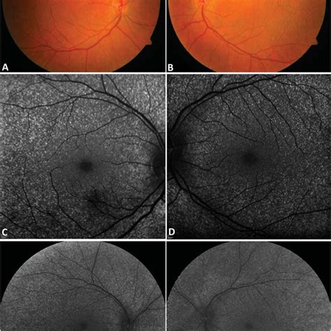 Color Fundus Photographs And Faf Images Of The Female Sibling At