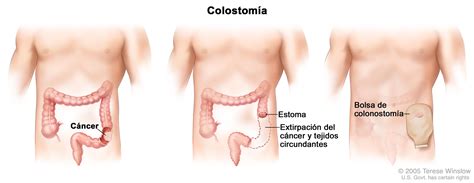 Tratamiento Del Cáncer De Colon Pdq®versión Para Pacientes