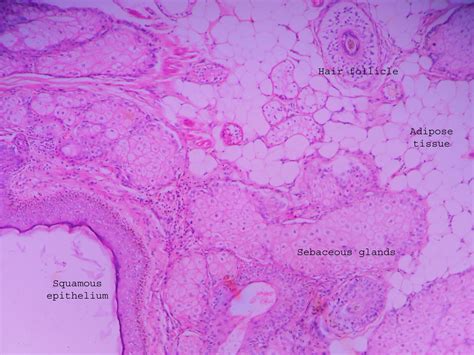 Dermoid Cyst Ovary Histopathology Guru