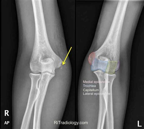Rit Radiology Medial Epicondyle Fracture Of The Humerus