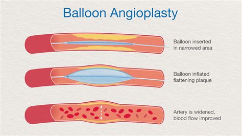 What Is Angioplasty