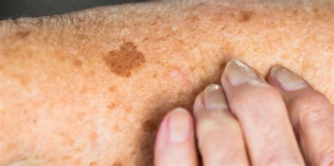How To Differentiate Harmless Sunspots From Skin Cancer Business