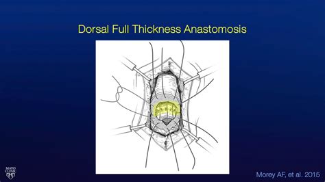 Mid Bulbar Urethroplasty Hybrid Excision And Primary Anastomosis