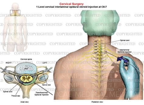 1 Level C6 7 Posterior Cervical Interlaminar Epidural Steroid