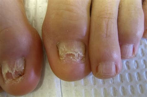 Fungal Nail Infection Causes Symptoms Treatment Pictures Healthmd