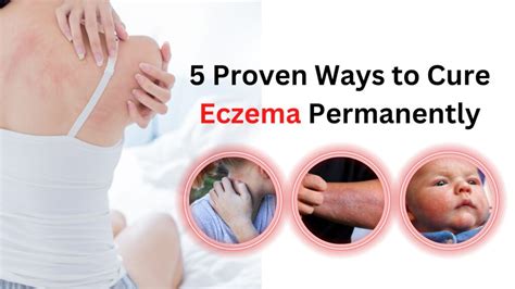 How To Cure Eczema Permanently 5 Proven Ways To Manage It