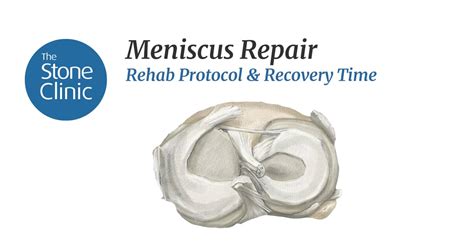 Meniscus Repair Surgery Rehab Protocol And Recovery Time