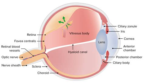 Retinal Detachment Concise Medical Knowledge