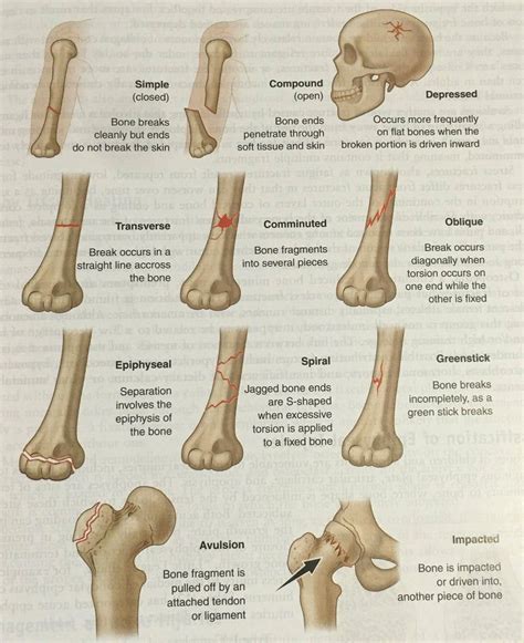 Online Lpn Programs Schoolnursesalary Types Of Fractures Orthopedic