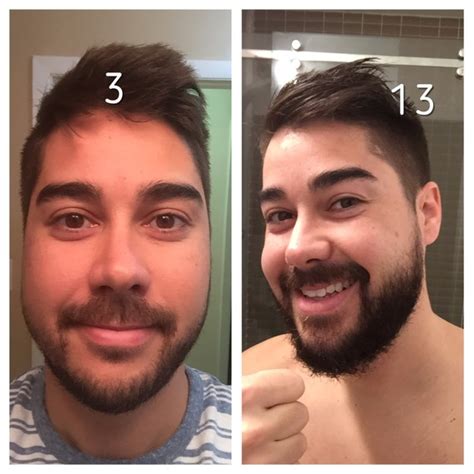 Patchy Beard Success Stories Before And After Photos Page 18 Beard