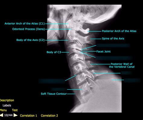Cervical Spine Lateral View Diagram Quizlet