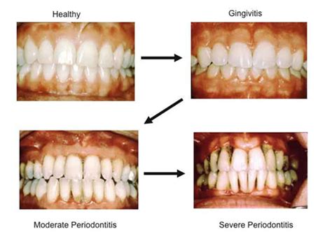 Etiology Of Periodontal Disease Taryn S Dental Hygiene Information