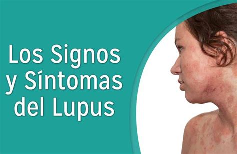 Lupus Síntomas ⊛ ¡prevención Y Tratamiento 2020