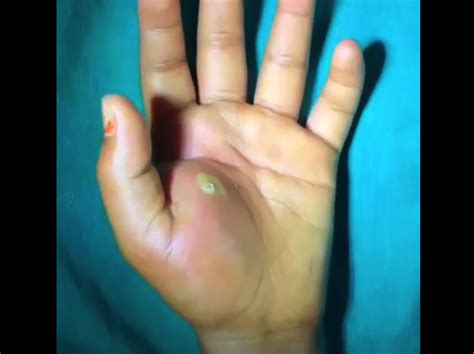 Hand Abscess Ppt Archives New Pimple Popping Videos