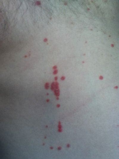 Rash On Left Side Of Stomach Pictures Photos