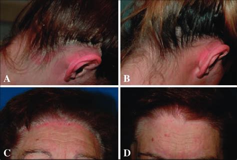 A Scalp Psoriasis Associated With Severe Itching And A Relevant Impact