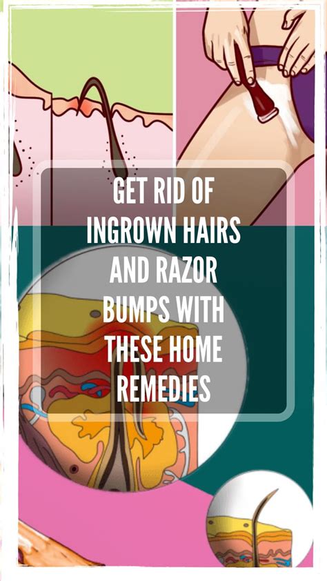 Get Rid Of Ingrown Hairs And Razor Bumps With These Home Remedies