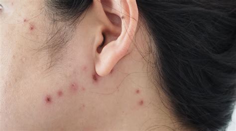 Chicken Pox Scars Treatments And Prices In Singapore