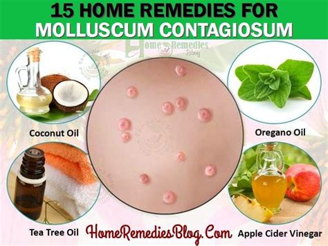 15 Home Remedies For Molluscum Contagiosum Natural Treatment With