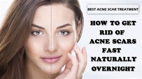 How To Get Rid Of Acne Scars Expert Advice