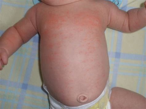 Homemade Remedies For Baby Rash Baby Rash