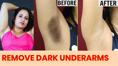 How To Lighten Underarms Naturally How To Get Rid Of Dark Underarms