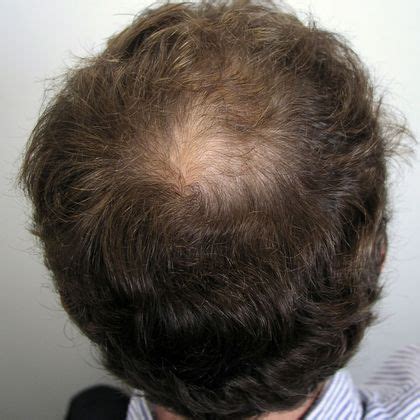 Male Before And After Crown Hair Restoration Photos