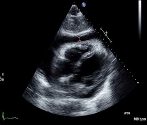 Echocardiogram Tte Subcostal View End Of Diastole Pericardial