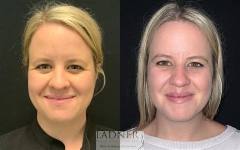 Brow Lift Forehead Lift Before And After Photo Gallery Denver Co