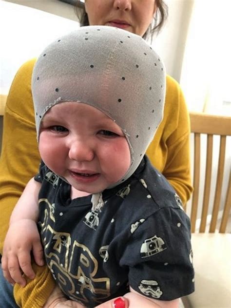 Baby Boy With Flat Head Now Wears Helmet For 23 Hours A Day