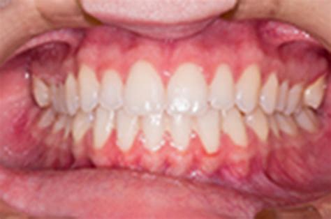 What Do Healthy Gums Look Like Oregon Careers In Healthcare