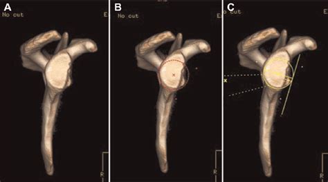 Figure 1 From Outcomes Of Latarjet Versus Distal Tibia Allograft For
