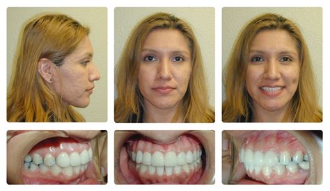 Invisalign Before And After Crowding