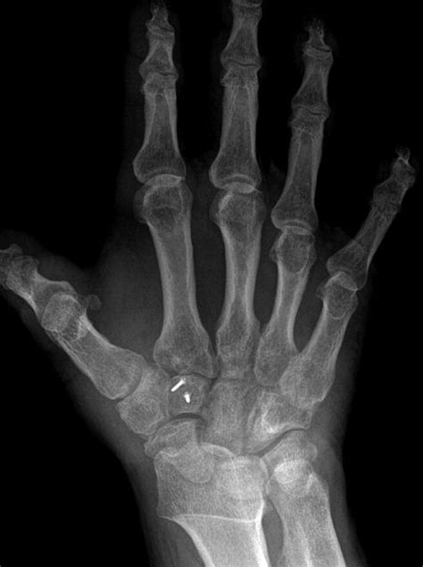 Palmar Dislocation of the Trapezoid With Coronal Shearing ...