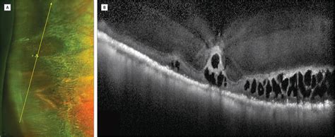 Optical Coherence Tomography Of An Ora Serrata Pearl