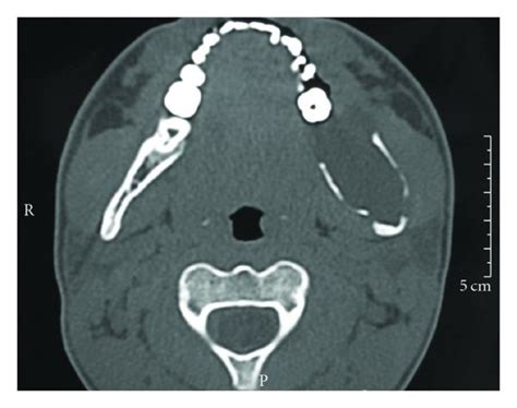Ct Axial A And Sagittal B Images Demonstrate The Lingual And Buccal