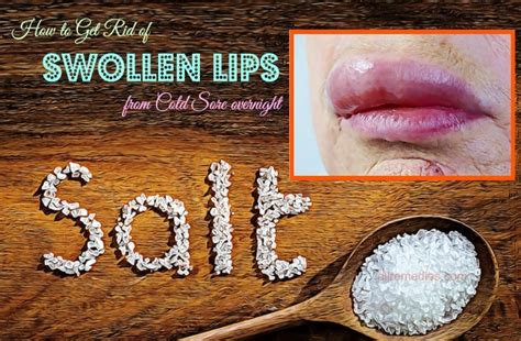 20 Tips How To Get Rid Of Swollen Lips From Cold Sore Overnight