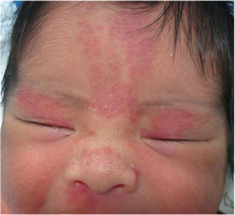 Neonatal Dermatologic Findings In Uruguay Epidemiology And