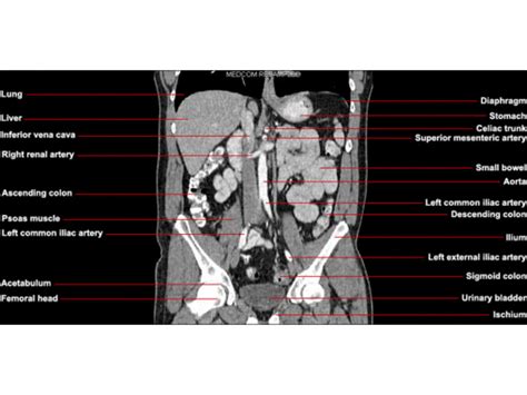 Ct Abdomen And Pelvis Coronal Anatomy In The Male Radiologypicscom