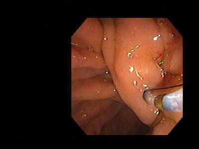 Ercp El Atlas Gastrointestinal Gastrointestinalatlas Com