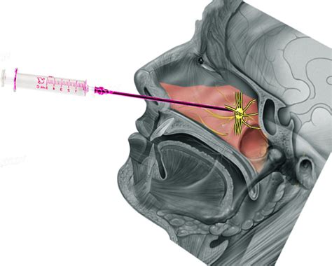 Figure Sphenopalatine Ganglion Image Courtesy S Bhimji MD