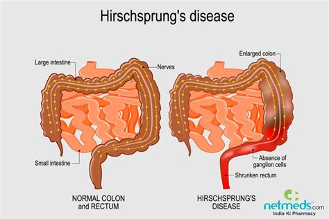 hirschsprung disease causes symptoms and treatment netmeds