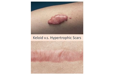 Keloid Acne Scars What Are They And How To Get Rid Of Them Dream Plastic Surgery