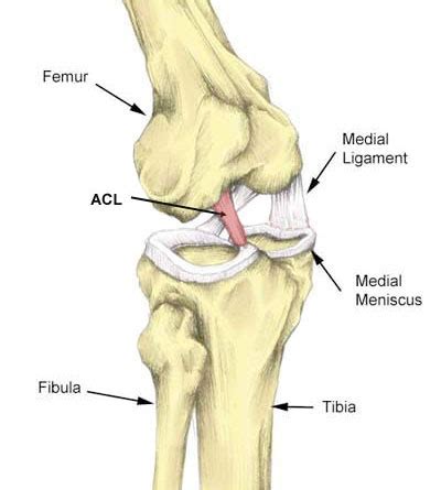 A torn acl is a common knee injury. ACL Sprain | Anterior Cruciate Ligament Sprain