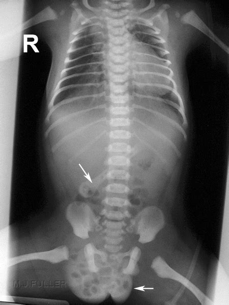 Imaging Abdominal Hernias Wikiradiography