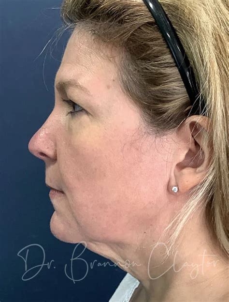 Facelift Philadelphia Pa Claytor Noone Facelift Philadelphia Lower Face Jawline And Neck