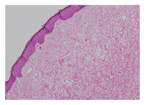 Fibroepithelial Stromal Polyp With A Hypercellular And Focal Myxoid