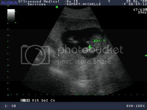16 Week Elective Ultrasound Boy Babycenter