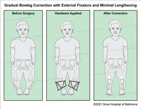 Bowlegs International Center For Limb Lengthening